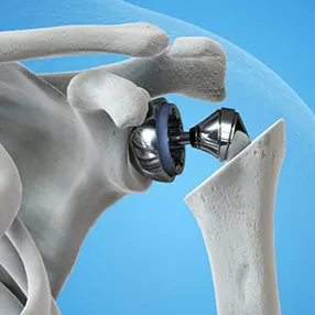 Artificial Shoulder